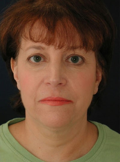 After Image: Neck Lift - front