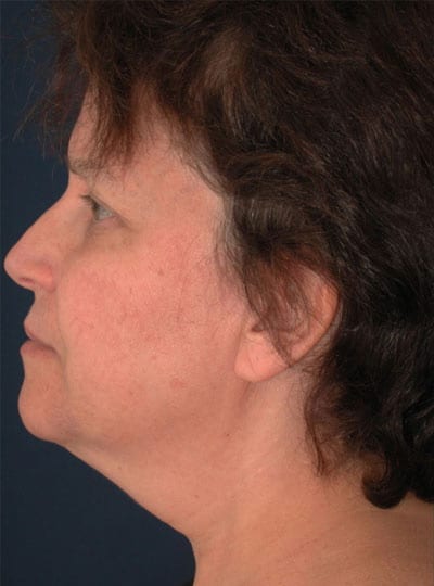 Before Image: Neck Lift - left-side