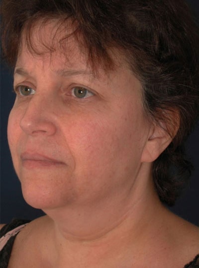 Before Image: Neck Lift - left-front-oblique