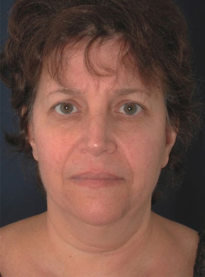 Before Image: Neck Lift - front