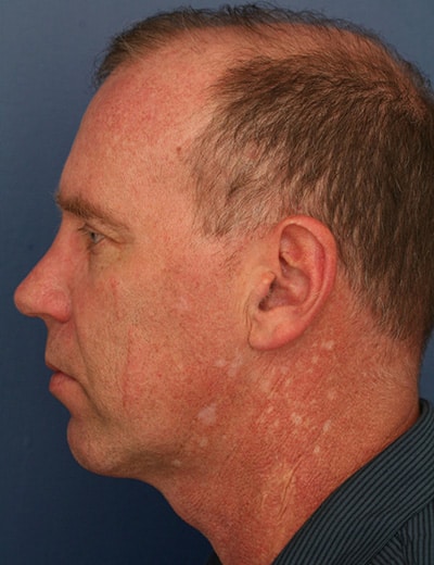 After Image: Neck Lift - left-side