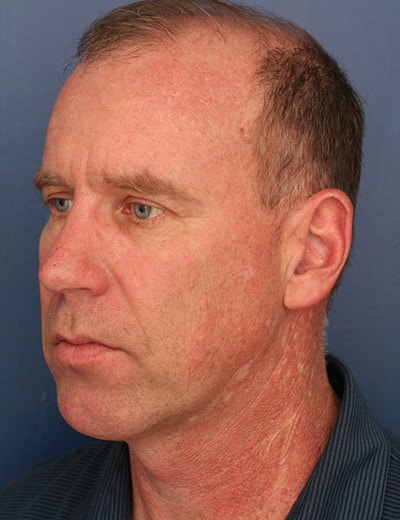 After Image: Neck Lift - left-front-oblique