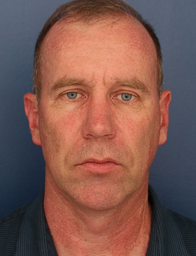 After Image: Neck Lift - front