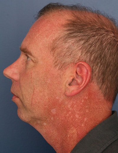 Before Image: Chin Surgery - left-side