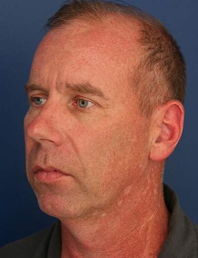 Before Image: Neck Lift - left-front-oblique