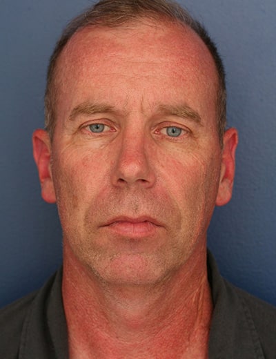 Before Image: Neck Lift - front