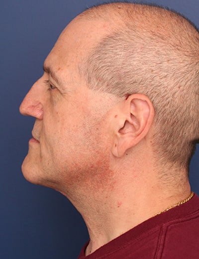 After Image: Neck Lift - left-side
