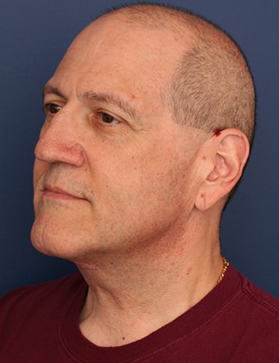 After Image: Neck Lift - left-front-oblique