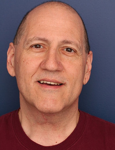 After Image: Neck Lift - front