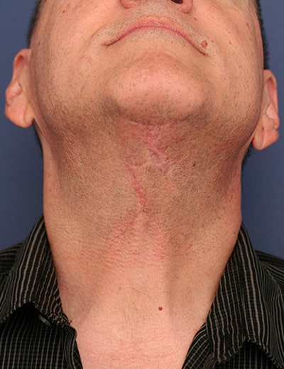 After Image: Neck Lift - front