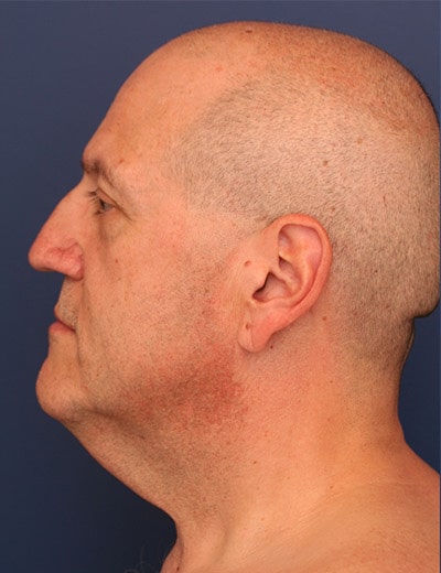 Before Image: Neck Lift - left-side