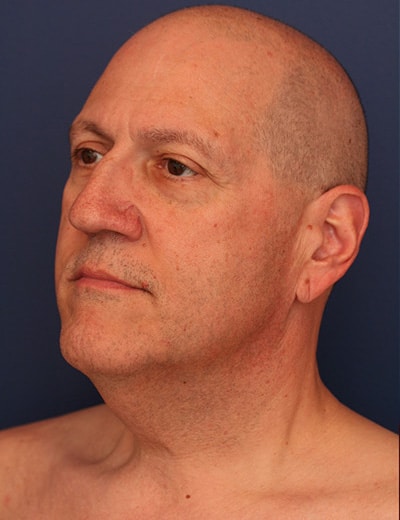Before Image: Neck Lift - left-front-oblique