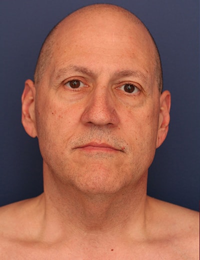 Before Image: Neck Lift - front
