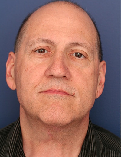 Before Image: Neck Lift - front