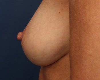 After Image: Inverted Nipple - left-side