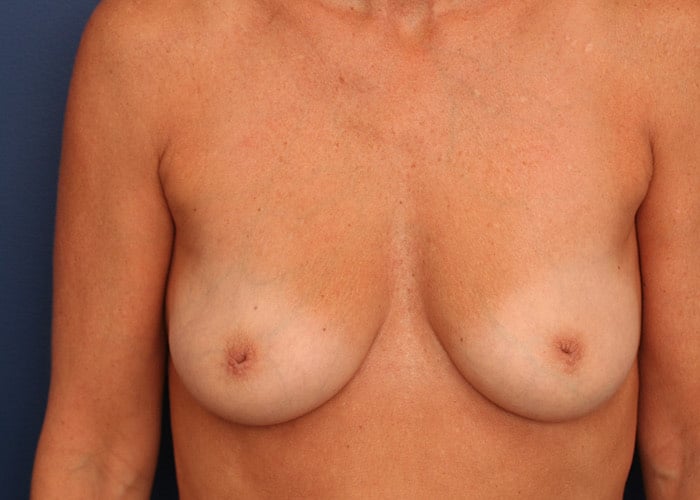 Before Image: Inverted Nipple - front