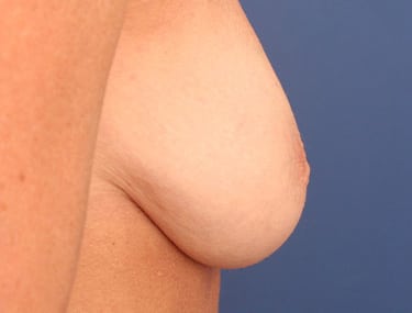 Before Image: Inverted Nipple - right-side