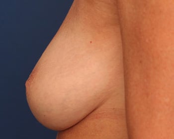 Before Image: Inverted Nipple - left-side