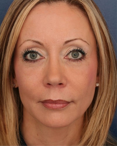 After Image: Eyelid and Facial Fillers - front