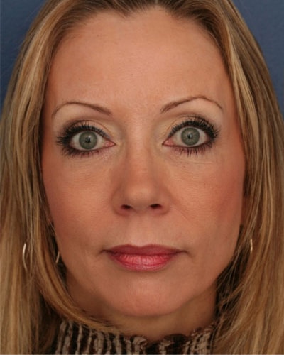 Before Image: Eyelid and Facial Fillers - front