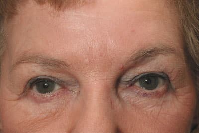 After Image: Non-surgical – Eyes - front
