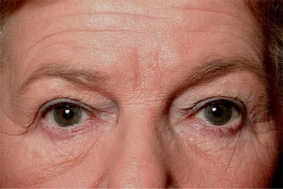 Before Image: Non-surgical – Eyes - front