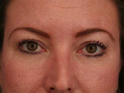 After Image: Non-surgical – Eyes - front