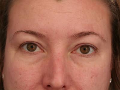 Before Image: Non-surgical – Eyes - front