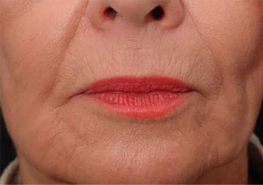After Image: Non-surgical – Lips - front