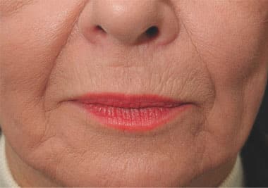 Before Image: Non-surgical – Lips - front