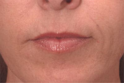 After Image: Non-surgical Lips - front