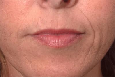 Before Image: Non-surgical Lips - front