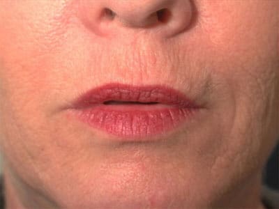 After Image: Non-surgical – Lips - front