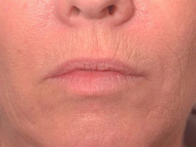 Before Image: Non-surgical – Lips - front