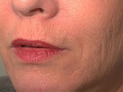 After Image: Non-surgical – Lips - left-front-oblique