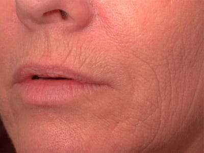 Before Image: Non-surgical – Lips - left-front-oblique