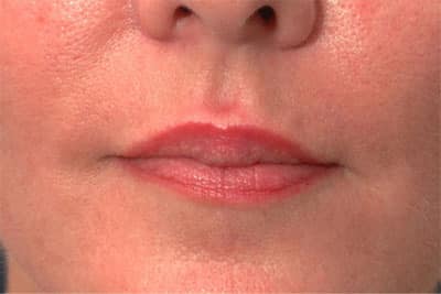 After Image: Non-surgical – Lips - front