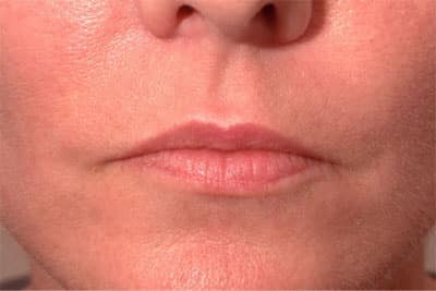 Before Image: Non-surgical – Lips - front