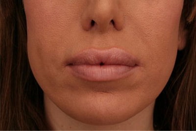 After Image: Non-surgical – Lips - front