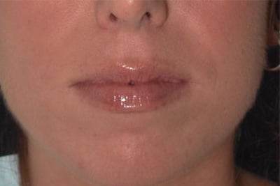 Before Image: Non-surgical – Lips - front