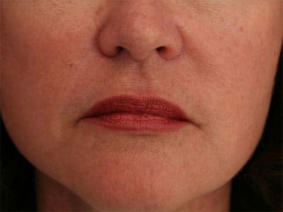 After Image: Non-surgical – Lips - front