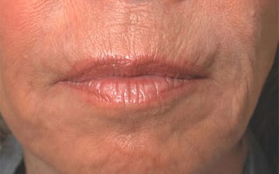 After Image: Non-surgical – Lips - front