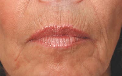 Before Image: Non-surgical – Lips - front