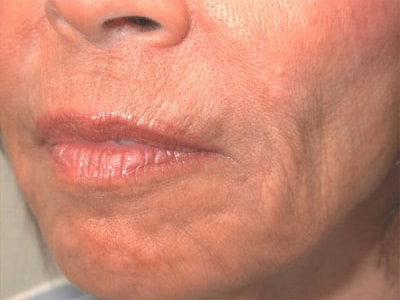 After Image: Non-surgical – Lips - left-front-oblique