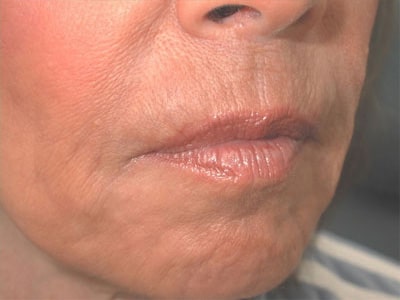 After Image: Non-surgical – Lips - right-front-oblique