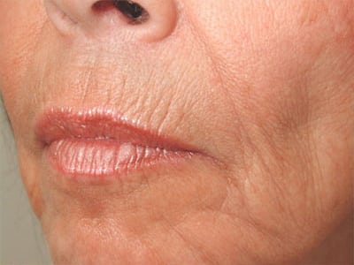 Before Image: Non-surgical – Lips - left-front-oblique