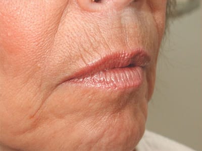 Before Image: Non-surgical – Lips - right-front-oblique