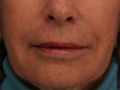 After Image: Non-surgical – Lips - front