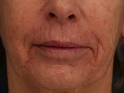 Before Image: Non-surgical – Lips - front
