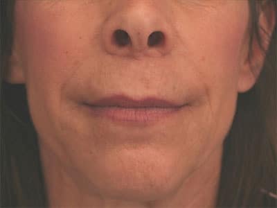 After Image: Non-surgical – Lips - front